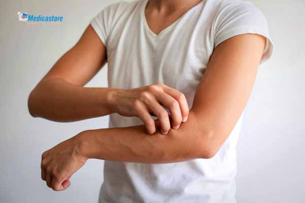Cara Efektif Mengobati dan Meredakan Eksim