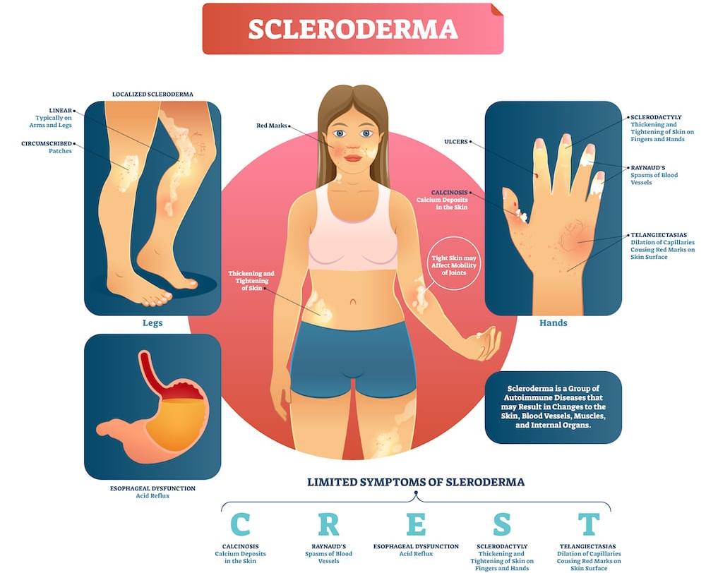 Skleroderma (Sklerosis Sistemik)