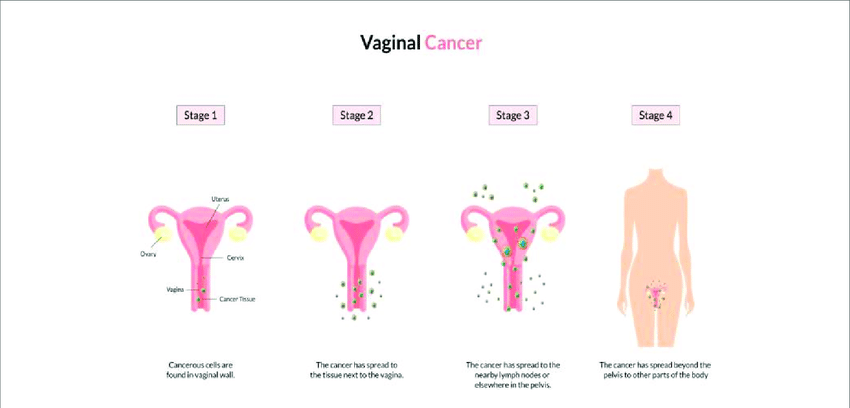Kanker Vagina