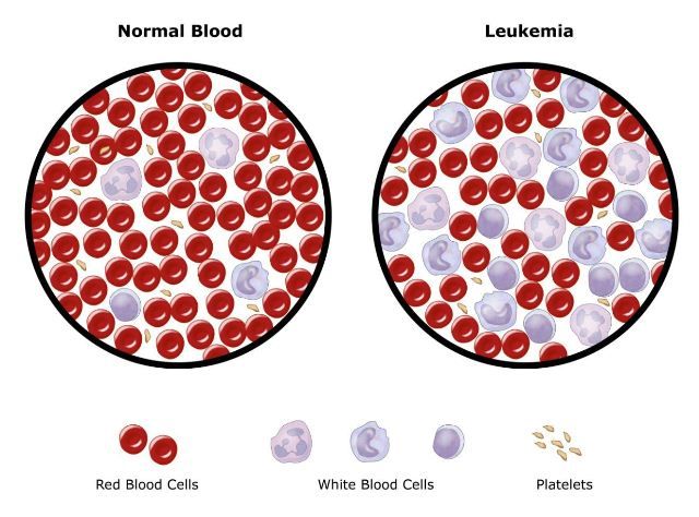 Leukemia (Kanker darah)