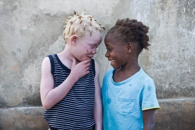 Albinisme (Albino)