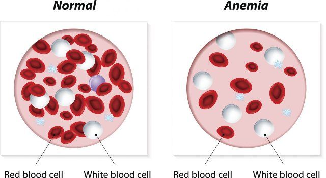 Anemia (Kurang Darah)