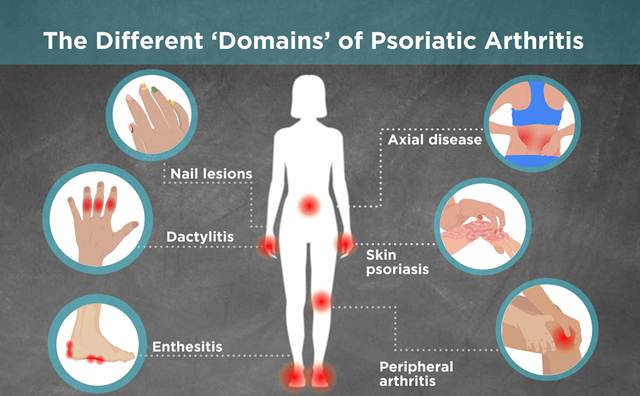 Radang Sendi Psoriasis (Artritis Psoriatik)