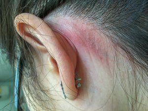 Dermatitis pada Telinga Bagian Luar