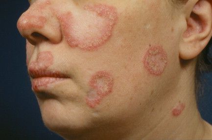 Lupus Eritematosus Diskoid