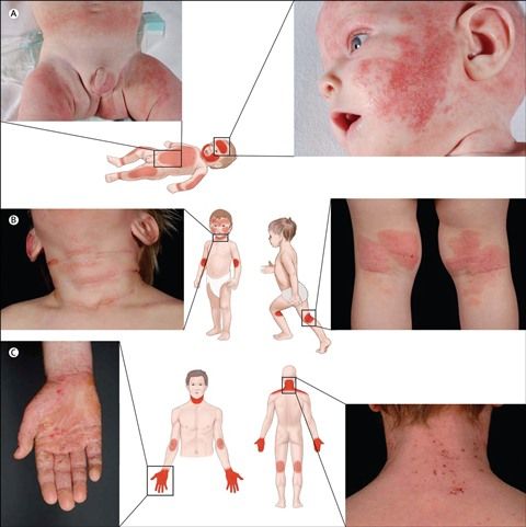 Dermatitis Atopi (Eksim)