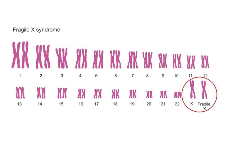Sindroma Fragile X