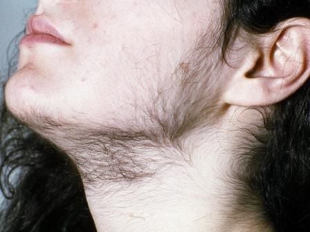 Rambut Tubuh Berlebihan (Excessive Hairiness)