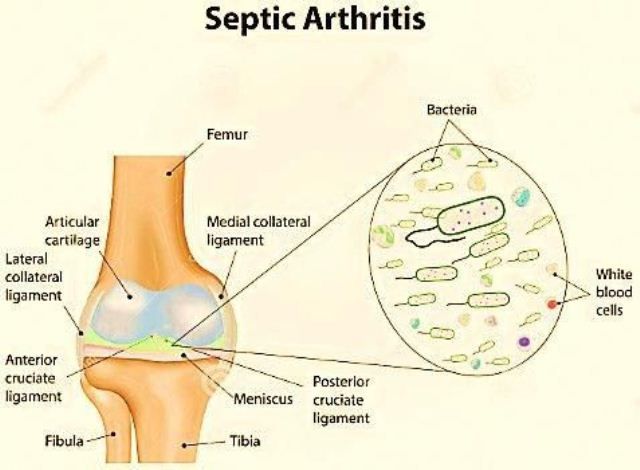 Artritis Infeksiosa