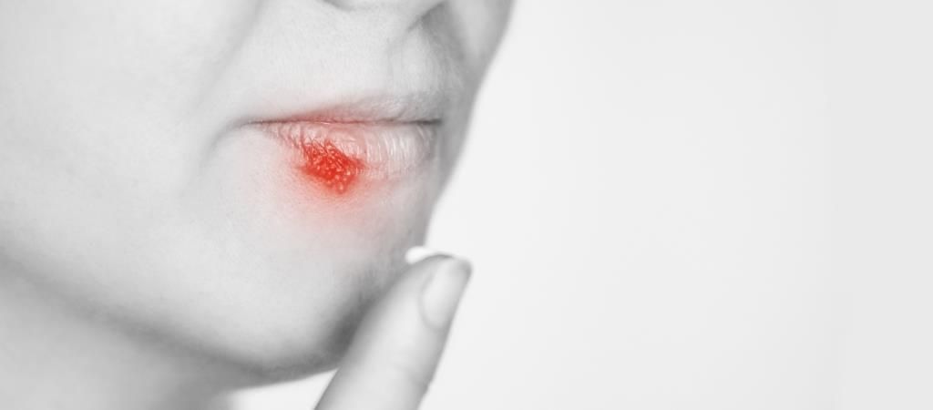 Infeksi Herpes Pada Mulut (Herpes labialis atau Cold Sore)