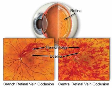 Kelainan Pembuluh Darah Retina