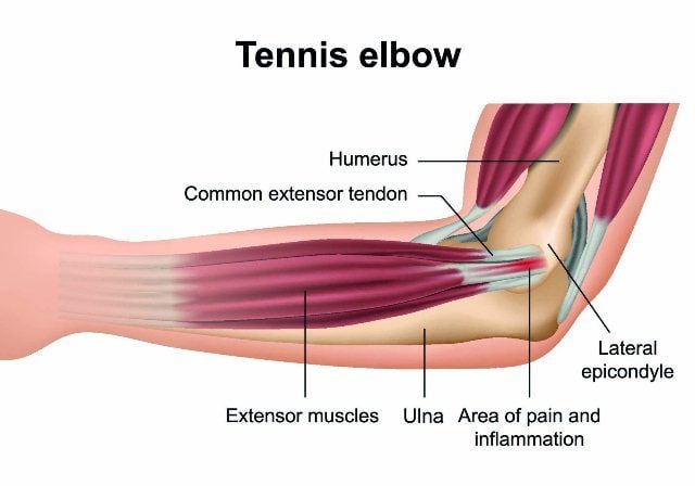 Epikondilitis Lateral (Tennis Elbow)