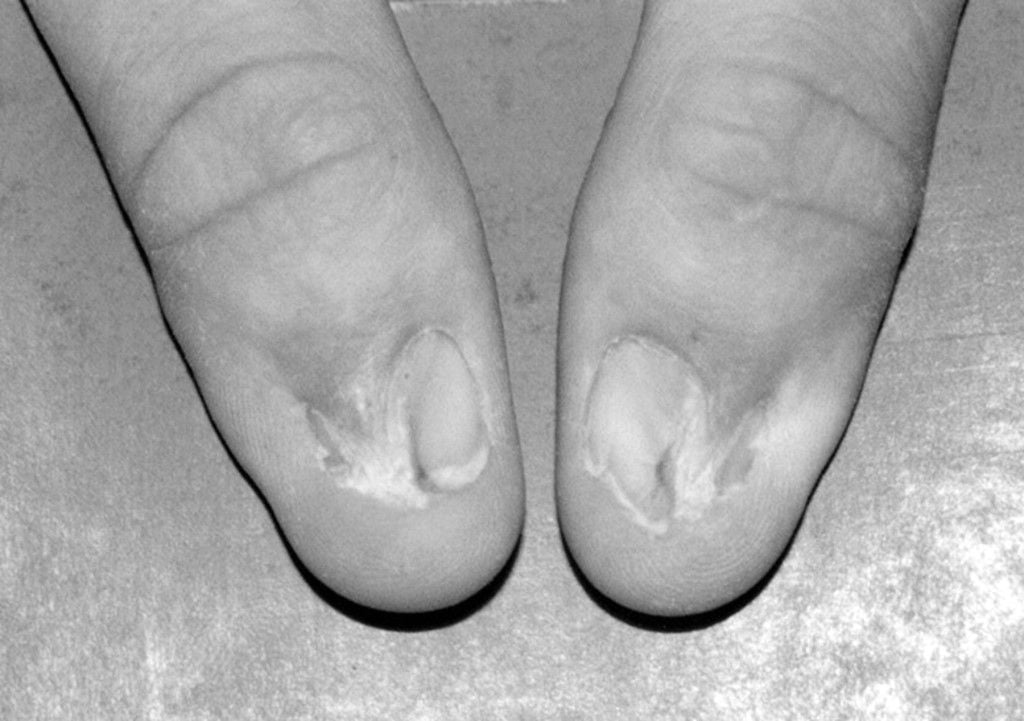 Nail patella Syndrome