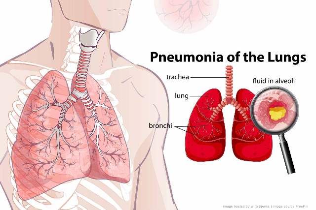 Pneumonia (Radang Paru)