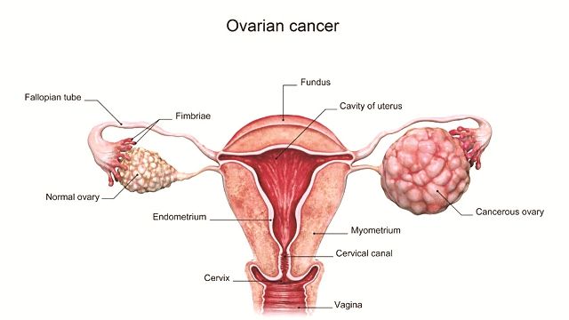 Kanker Ovarium (Kanker Indung Telur)