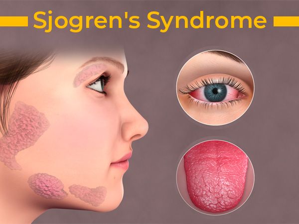 Sindroma Sjogren
