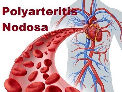 Poliarteritis Nodosa