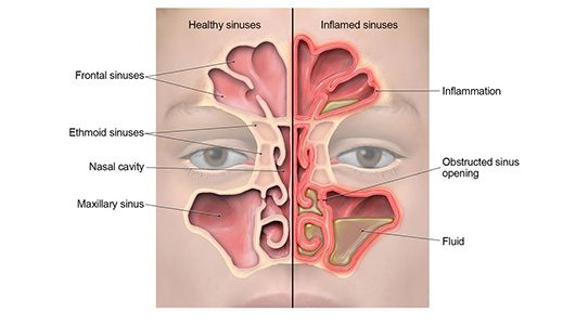Sinusitis (Radang Sinus)
