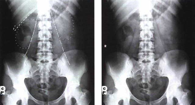Foto Sinar-X Ginjal, Ureter dan Kandung Kemih