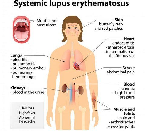 Lupus Eritematosus Sistemik