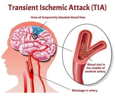 Serangan Iskemik Sesaat (Transient Ischemic Attacks, TIA)