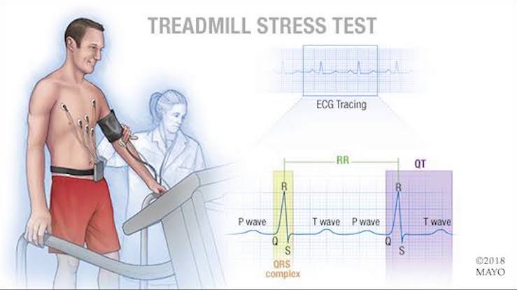 Elektrokardiografi dengan Latihan (Stress Test)