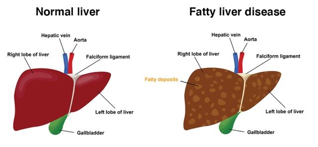 Perlemakan Hati (Fatty Liver)