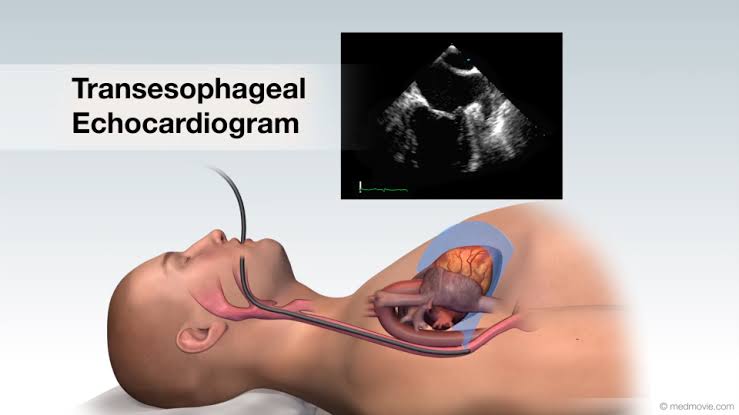 Ekokardiografi Transesofageal