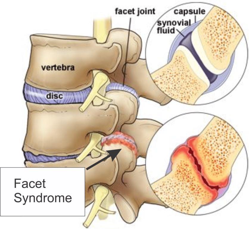 Facet Joint Syndrome 