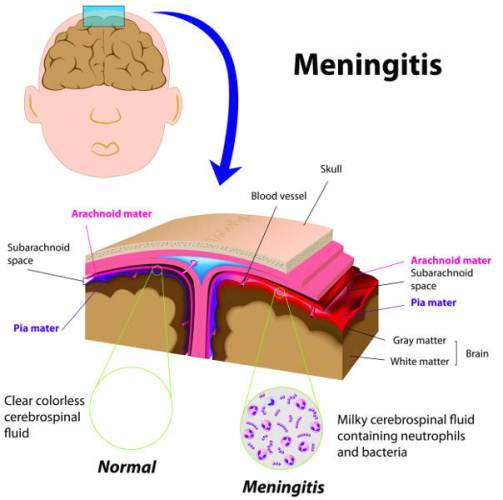 Meningitis Kronis