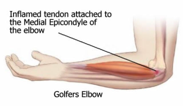 Epikondilitis Medial (Golfers Elbow)