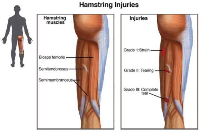 Cedera Otot Hamstring