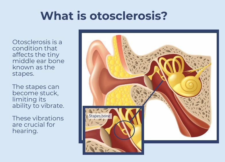 Otosklerosis
