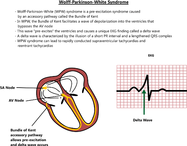 Sindrom Wolff-Parkinson-White