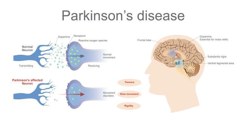 Penyakit Parkinson