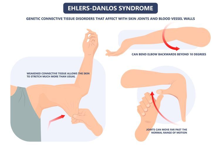 Sindroma Ehlers-Danlos