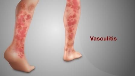 Vaskulitis (Radang Pembuluh Darah)