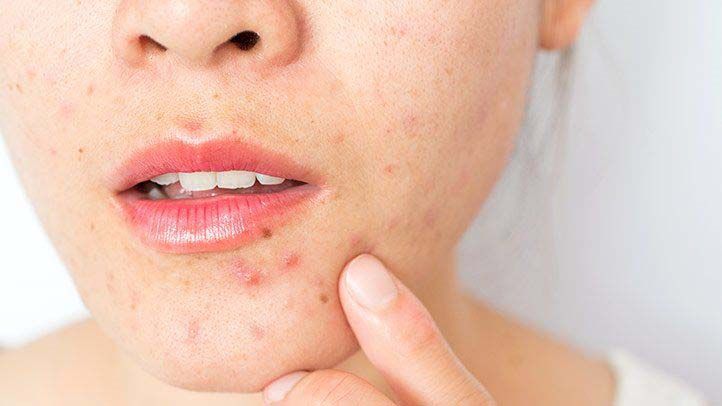 5 Manfaat Jf Acne Care Untuk Perawatan Kulit Dan Wajah