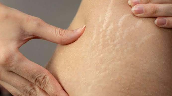 Bio Oil, Produk Perawatan Kulit untuk Hilangkan Bekas Luka & Stretch Mark