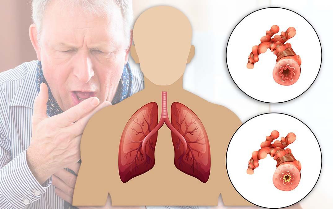 COPD adalah Penyakit Paru Obstruktif Kronik, Begini Cara Terapinya