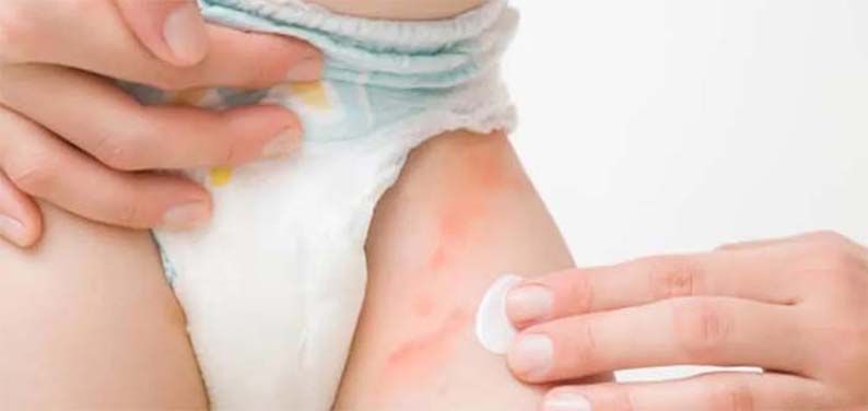 Ceradan Diaper Cream, Krim Pelembab Atasi Ruam Popok pada Bayi