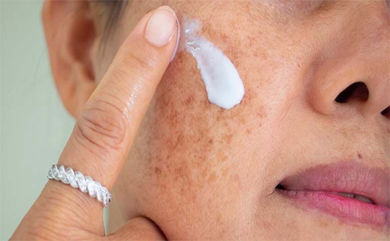 Hilangkan Flek Hitam pada Kulit dengan Vitaquin Cream