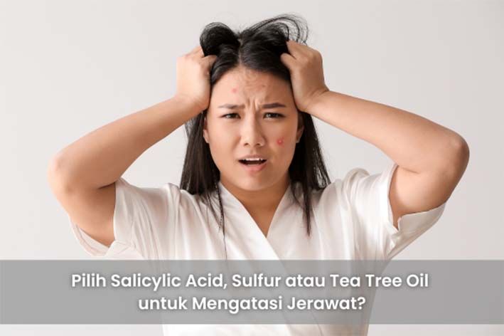 Pilih Salicylic Acid, Sulfur atau Tea Tree Oil untuk Mengatasi Jerawat?