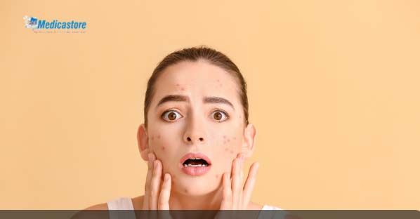 Tips Mencegah Terjadinya Jerawat dengan Mudah