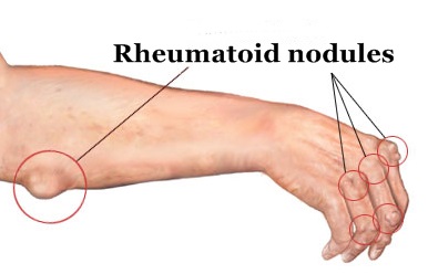 benjolan pada radang sendi akibat reumatoid arthritis