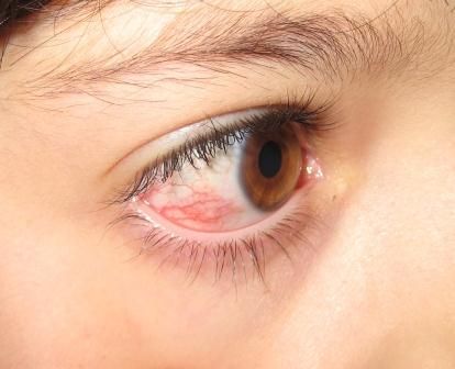 penyebab mata merah episkleritis