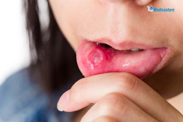 Sariawan dan infeksi jamur di mulut