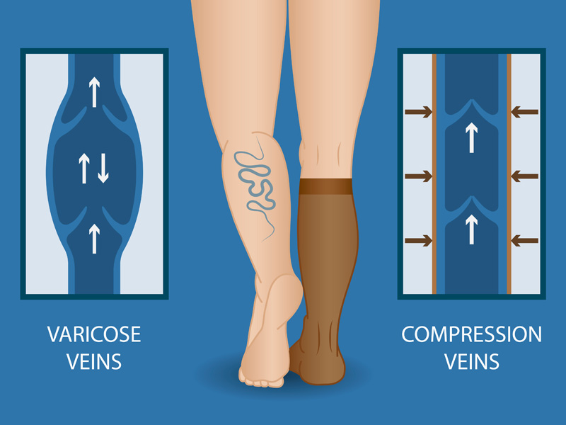 stoking untuk varises pada kaki