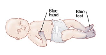 akrosianosis; tangan dan kaki biru pada bayi baru lahir