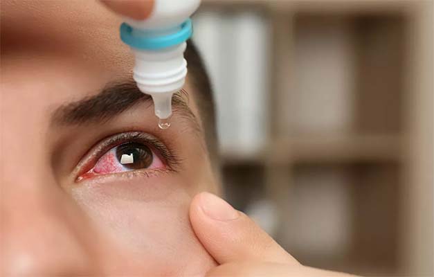 Obat iritasi mata ringan